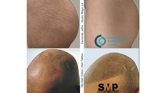 Skin camouflage – Crewe Hair and Skin Clinic 01270 747 393
